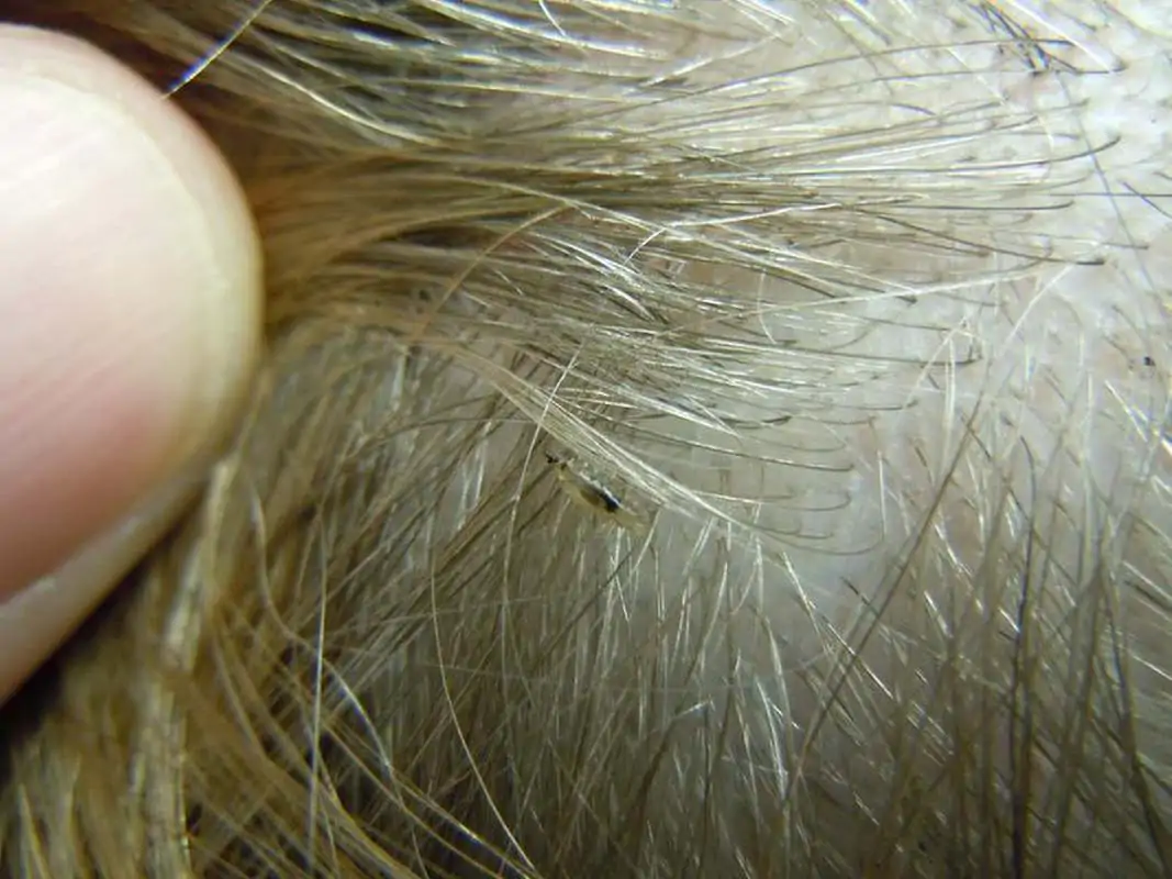 Head louse on hair